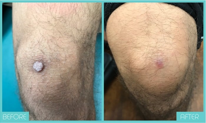 Skin Tags Removal Tampa | Mole Removal Before and After | Skintellect