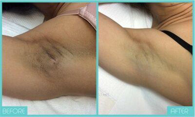 Underarm Before & After Bleaching