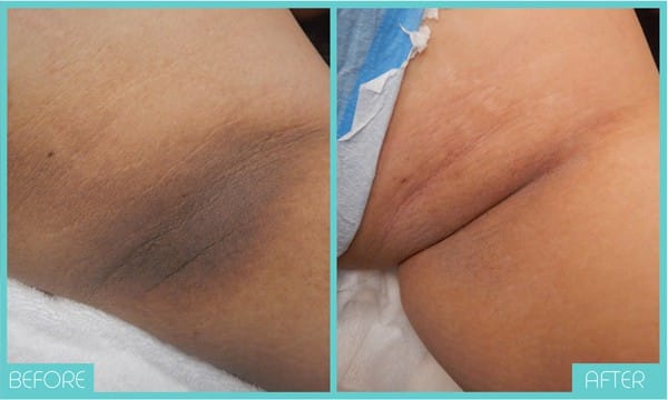 Laser Intimate Skin Bleaching Tampa Private Area Lightening 