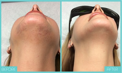 Laser Hair Removal | Before and After Chin | Skintellect