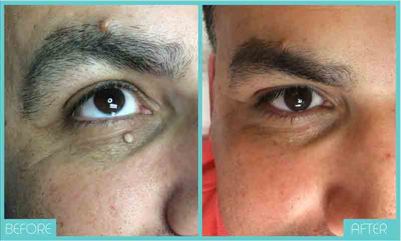 Skin Tag Removal Before and After | Skintellect