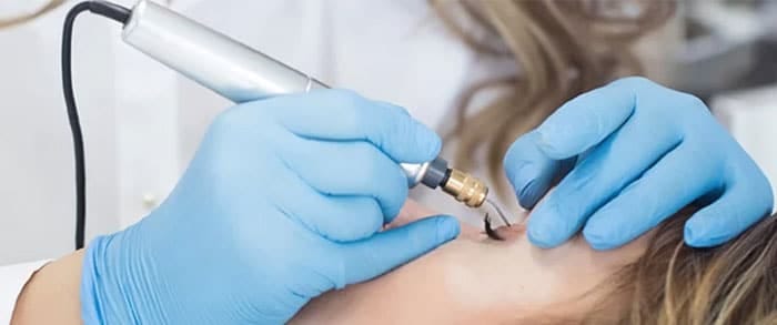 Fibroblast | Plasma Pen | Skintellect