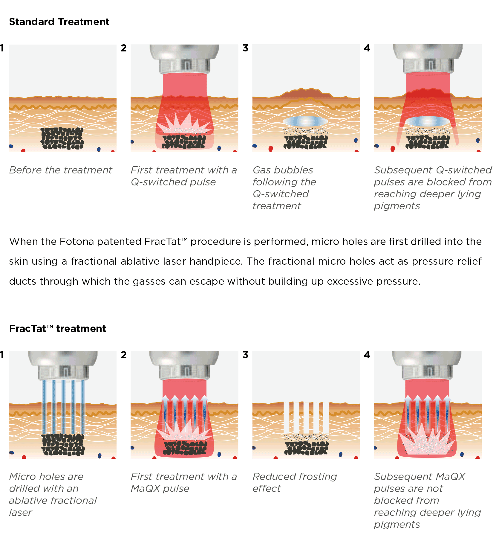 Diagram explaining what makes FracTat Laser Tattoo Removal technology stand out at Skintellect Laser & Aesthetics in Tampa