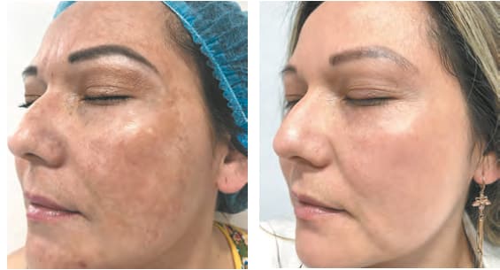 Melasma Before and After | Skintellect