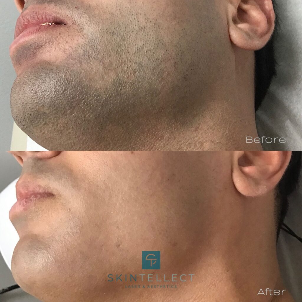 laser hair removal for men before and after