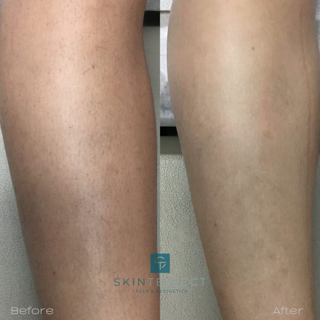 laser hair removal legs before and after