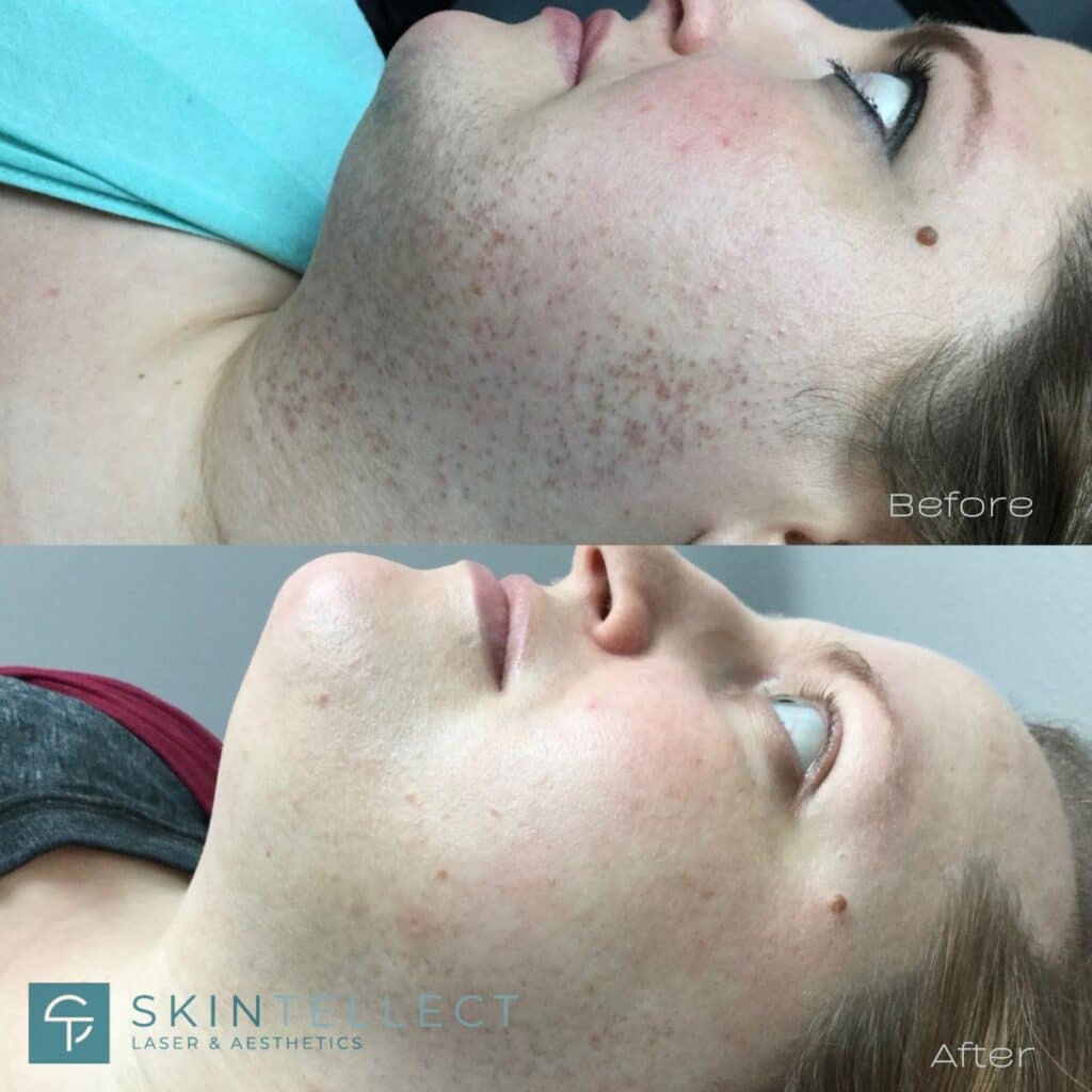 laser hair removal before and after face