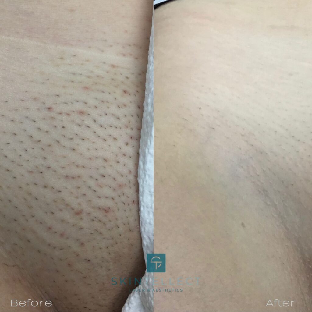 laser hair removal legs before and after