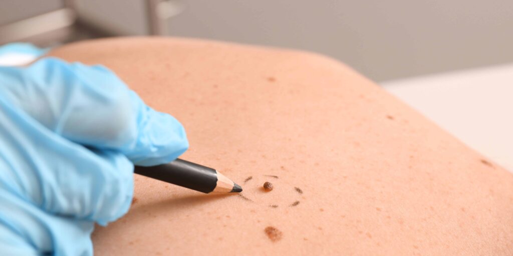 Skin Tags | Mole Removal | skintellect