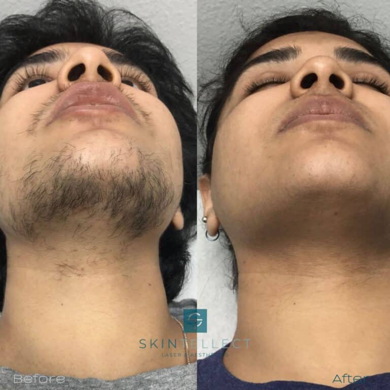 Men's facial laser hair removal treatment in Tampa