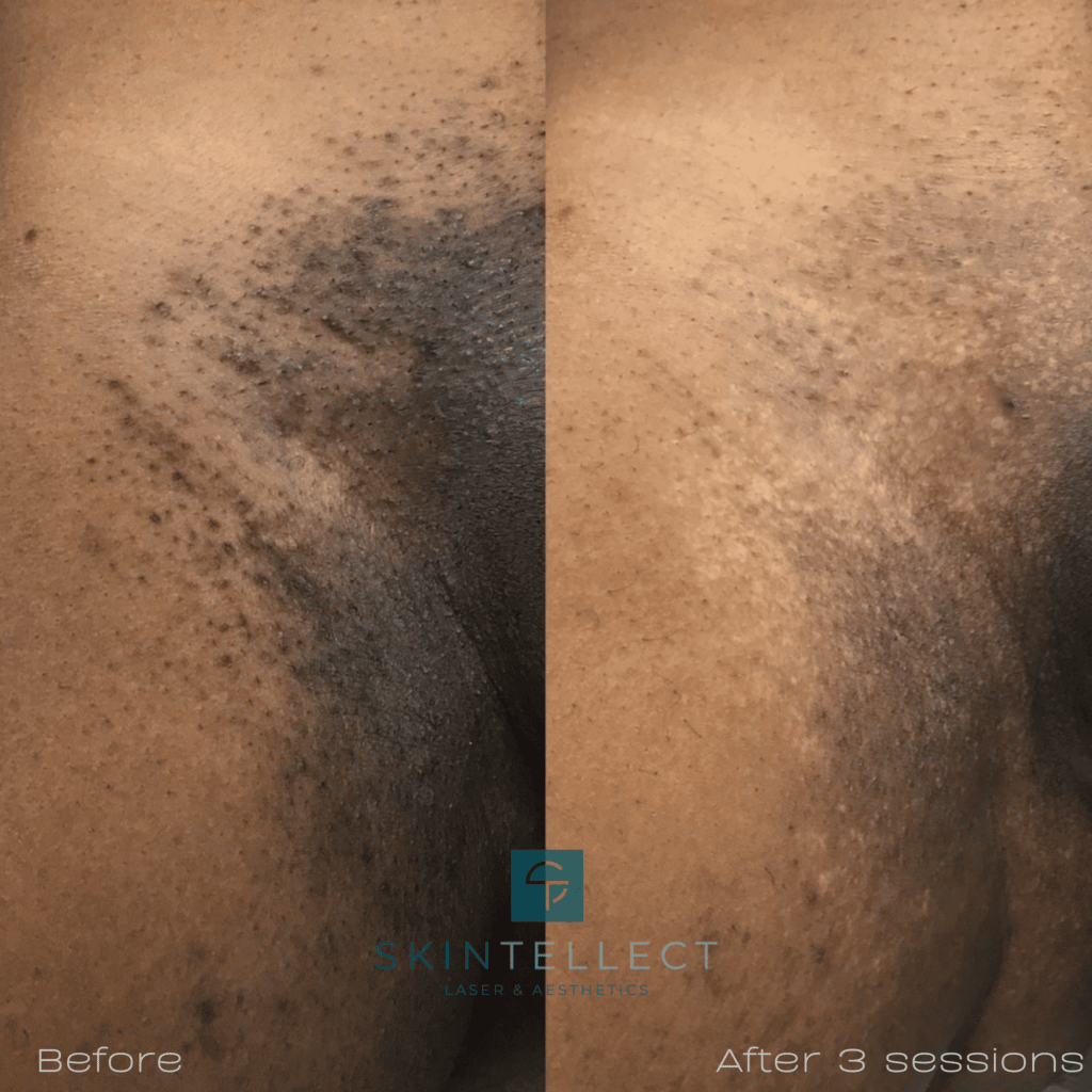 Pubic Full Brazilian Laser Hair Removal Before And After Photos Best Hairstyles Ideas For