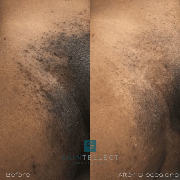 Laser Hair Removal Before & After | Skintellect
