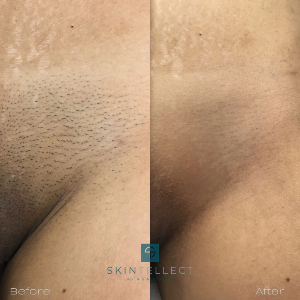 Laser Hair Removal Before & After | Skintellect