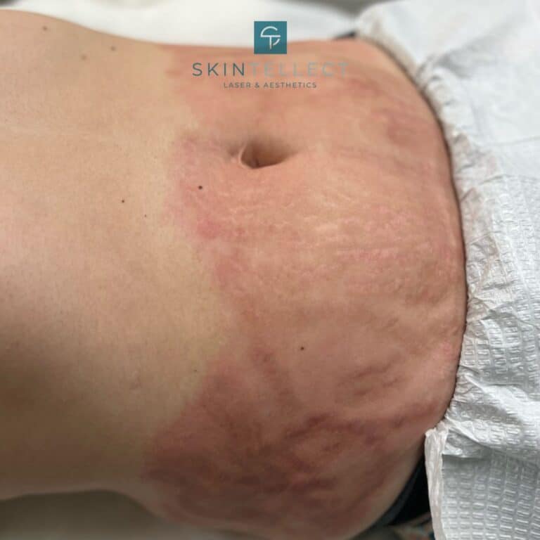 Stretch Mark Removal | Skintellect