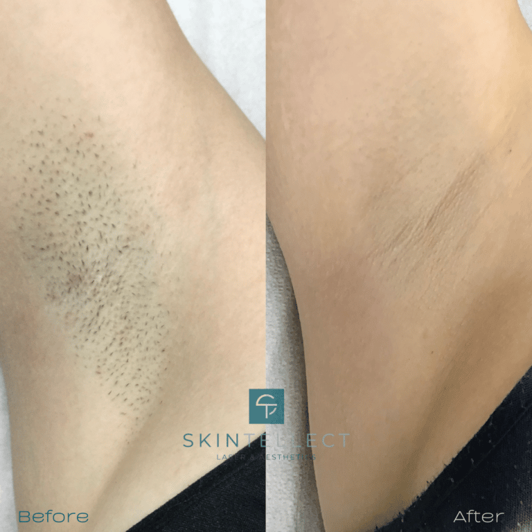 Underarm laser hair removal treatment in Tampa