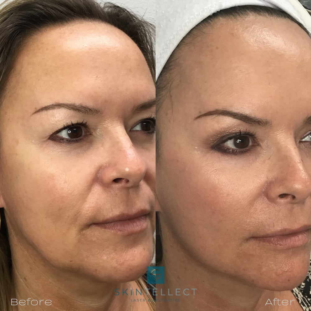 Fotona 4D Lift Laser Skin Tightening Skintellect