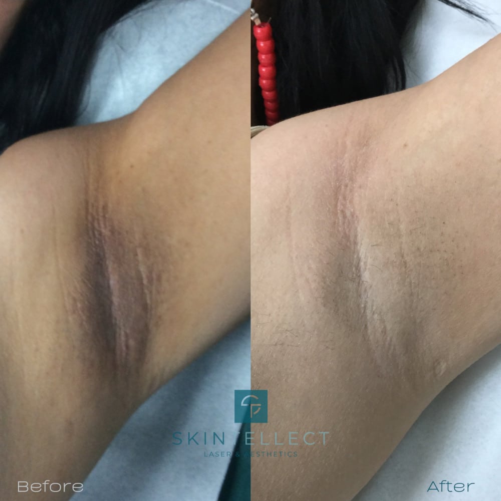 Before and after of underarm intimate lightening showing noticeable improvement in pigmentation.