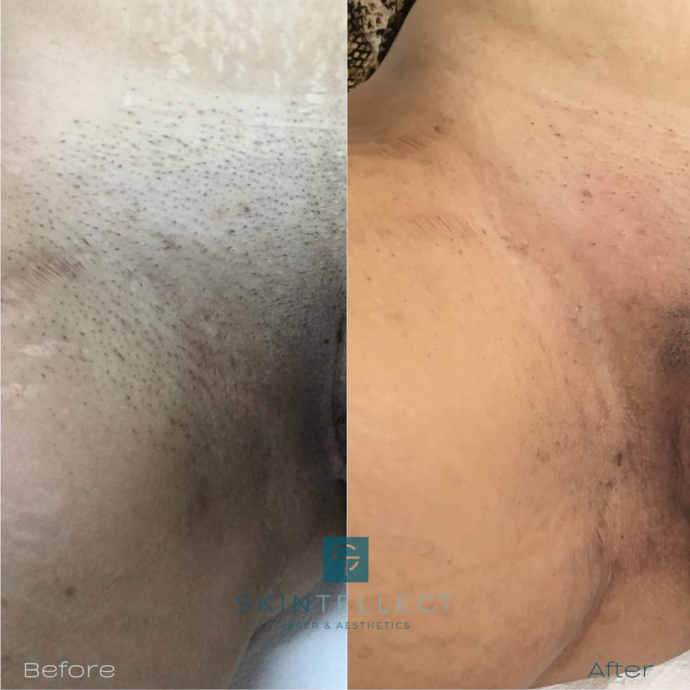 Anoi tumor voor de hand liggend Laser Skin Lightening Tampa | Before And After Pictures