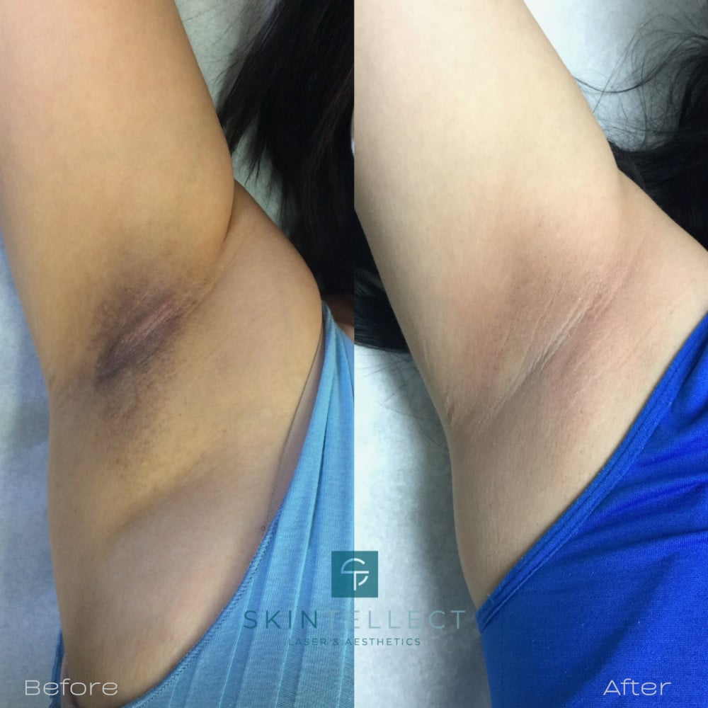 Laser Treatment for Dark Inner Thigh