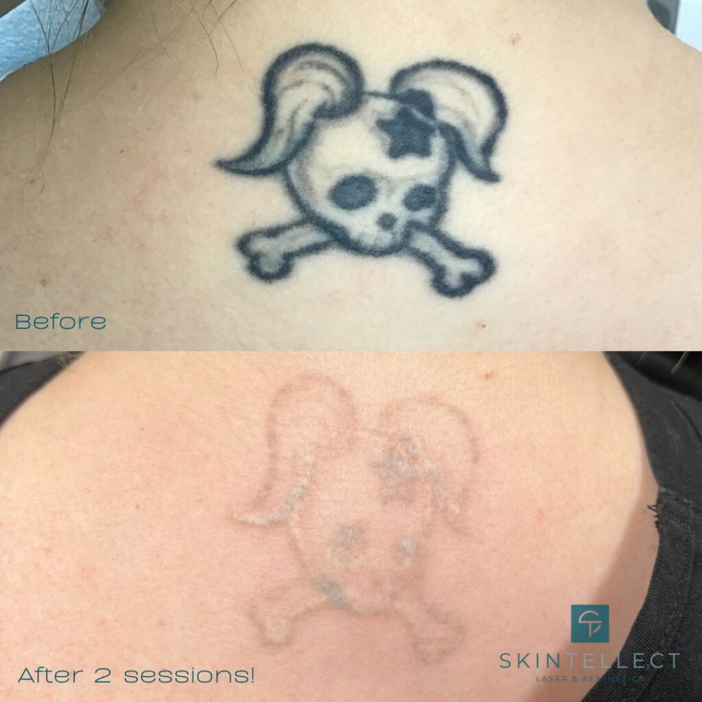 Fifth session of laser tattoo removal is complete Removery Laser Tat   TikTok