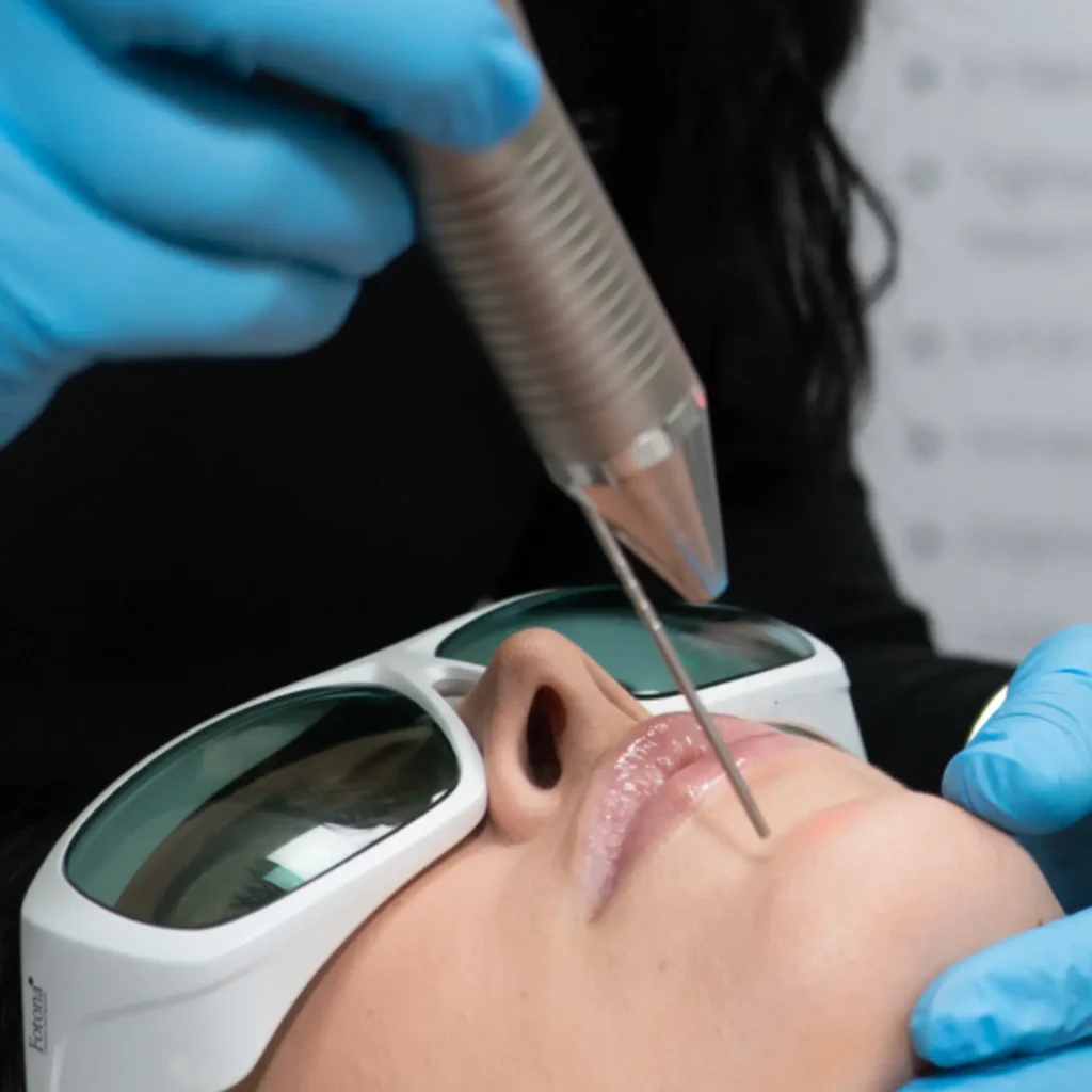 Skilled technician performing Fotona 4D Laser Facelift for a natural skin lifting effect.