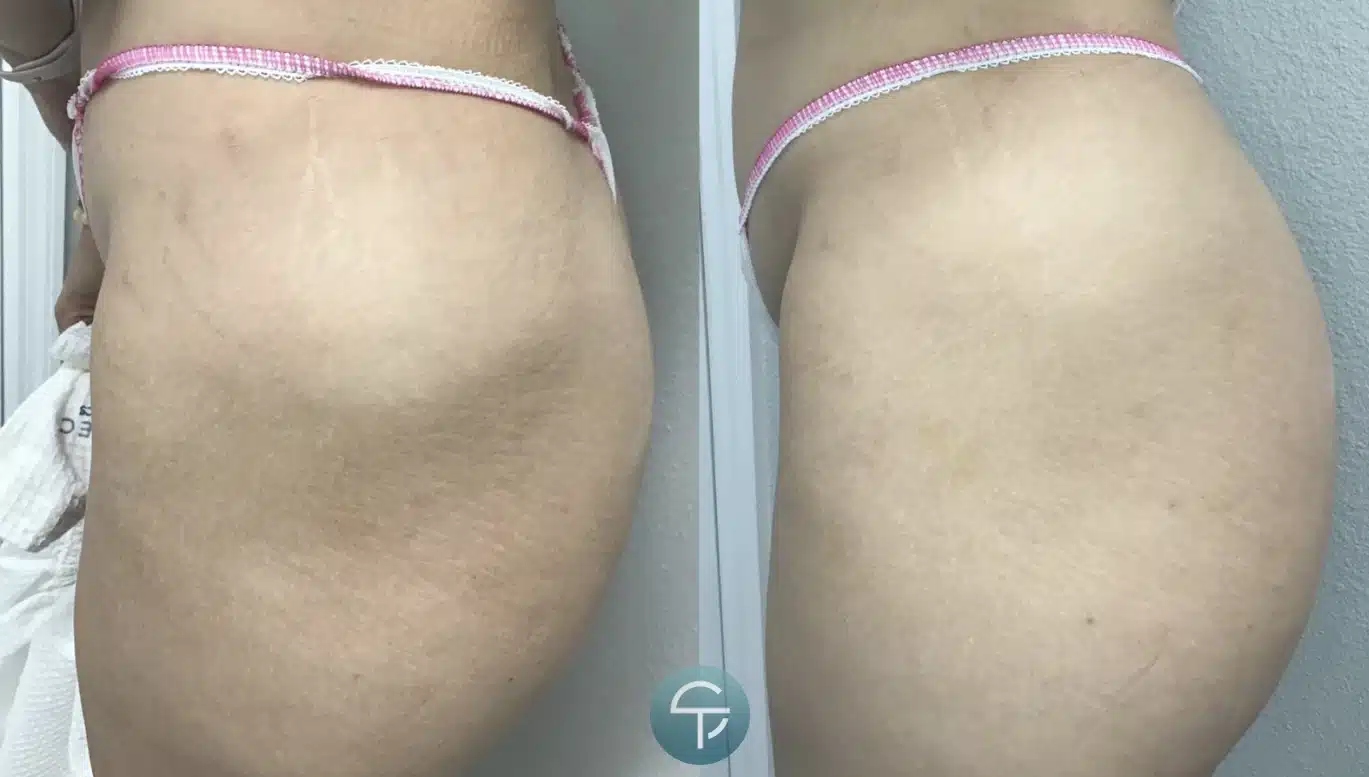 MultiShape Body Contouring Before and after