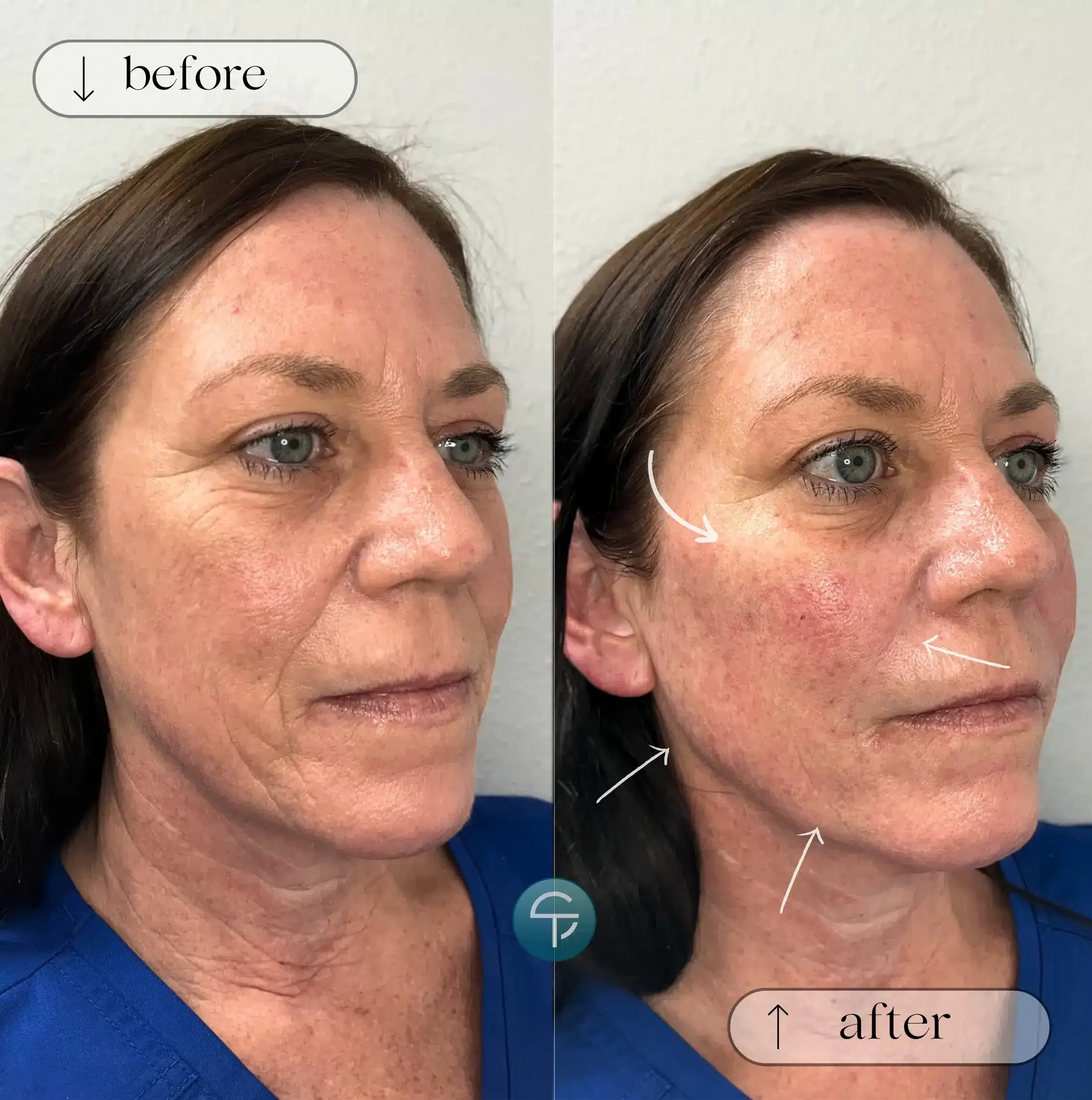 Face before and after two vials of Sculptra, showing smoother lines, added volume, and a more youthful, fuller appearance.