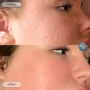 Before and after of ClearLase treatment for pitted acne scars, showing smoother skin texture.