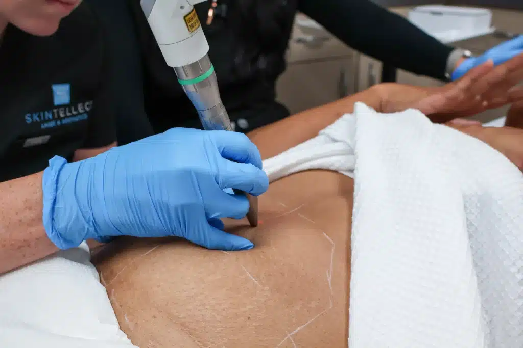 Patient receiving laser treatment for scar and stretch mark removal Tampa