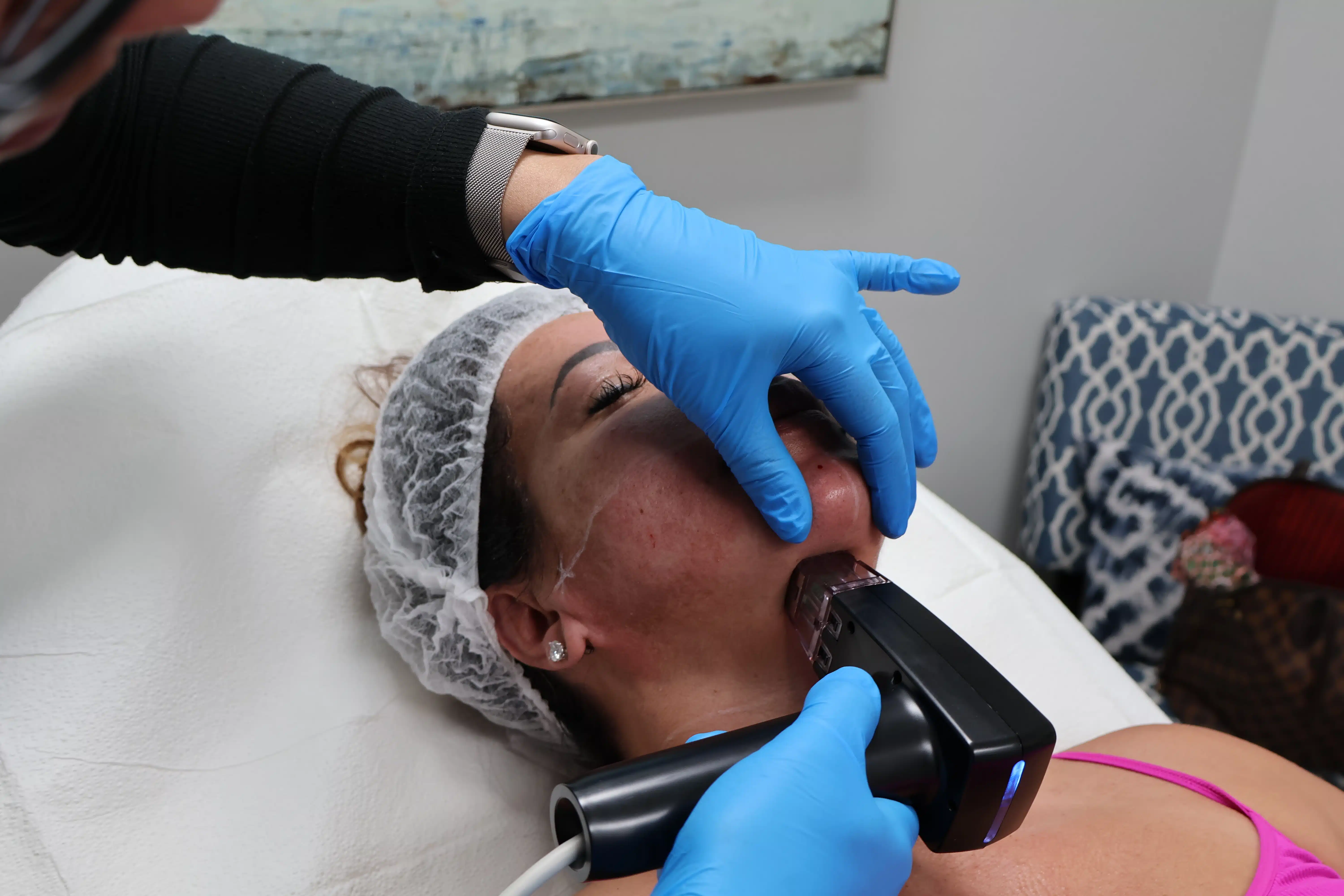 Patient undergoing Morpheus8 treatment for skin tightening and collagen stimulation.