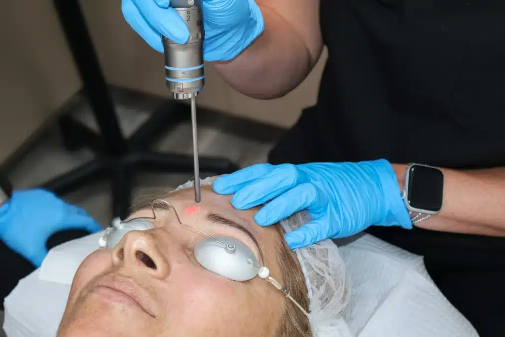 Patient receiving laser pigment removal treatment to target sunspots and discoloration.