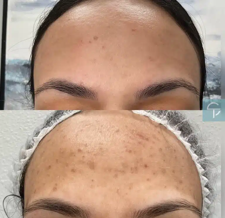Before and after laser pigment removal showing reduced sunspots on the face.
