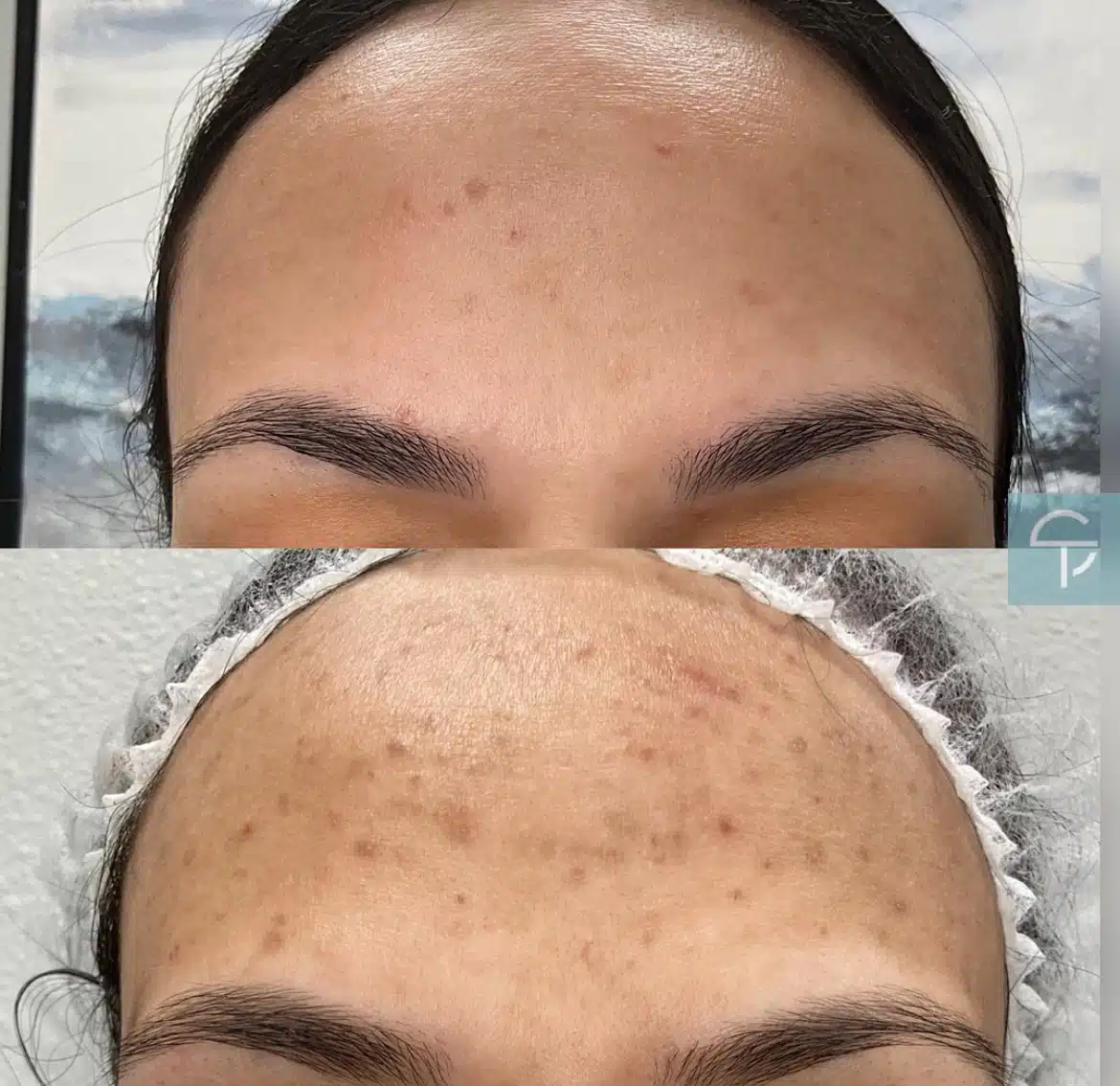 Before and after laser pigment removal showing reduced sunspots on the face.