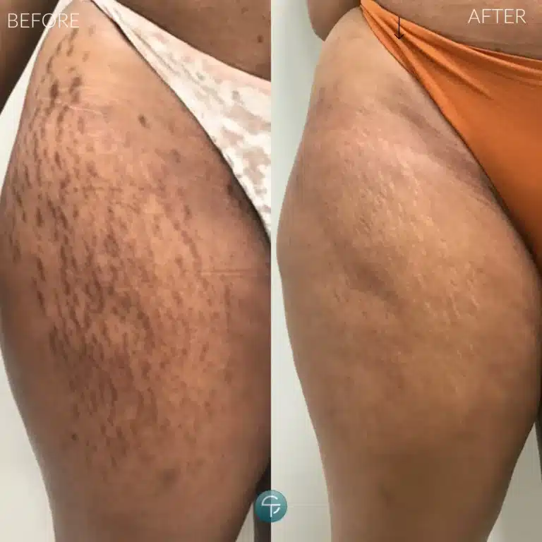 Laser Stretch Mark Removal | 4 Sessions