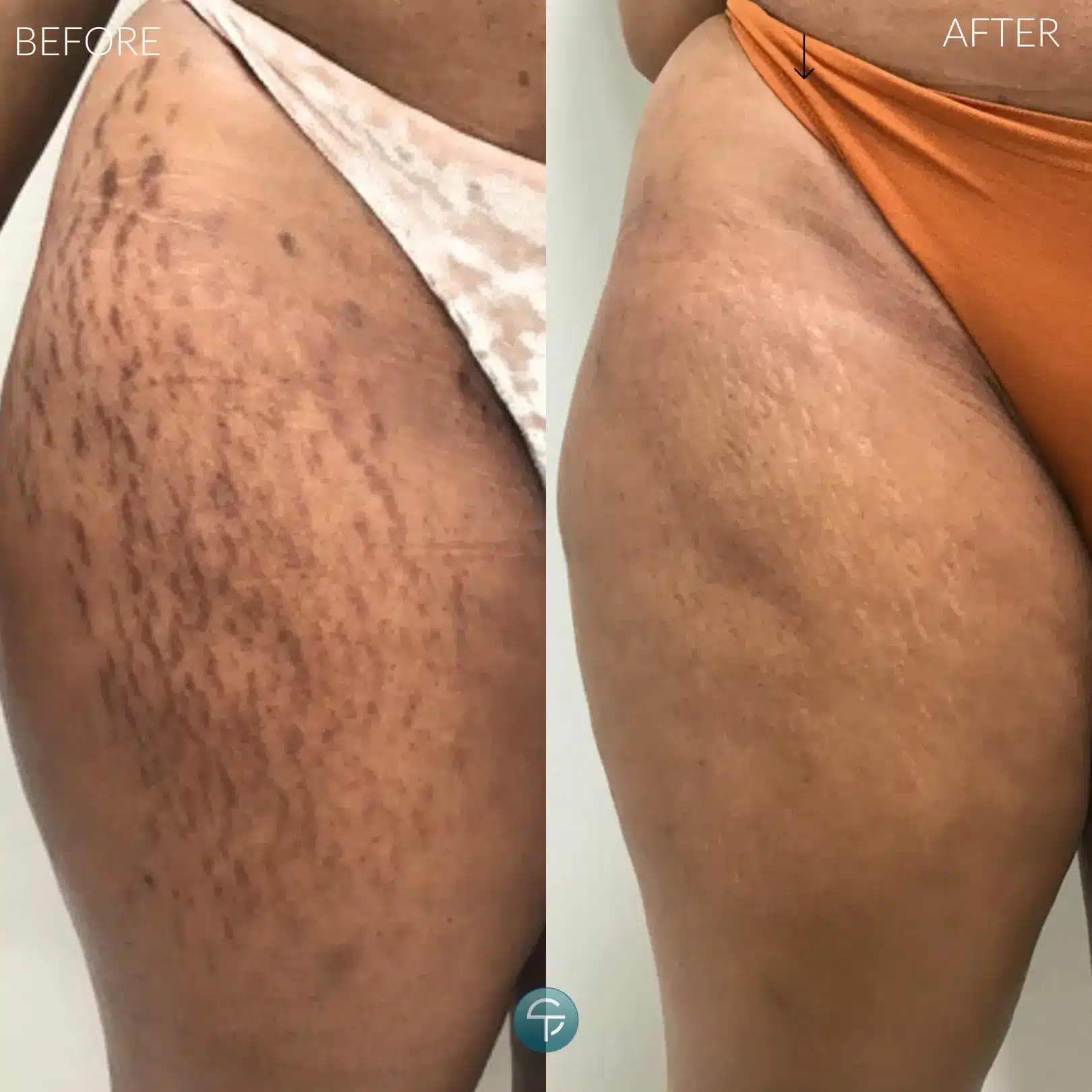 Laser Stretch Mark Removal | 4 Sessions