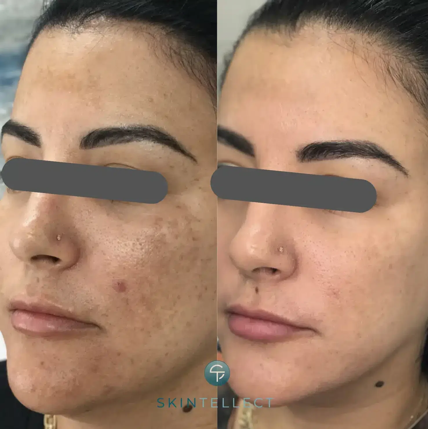 Laser Pigment Removal | 3 Sessions