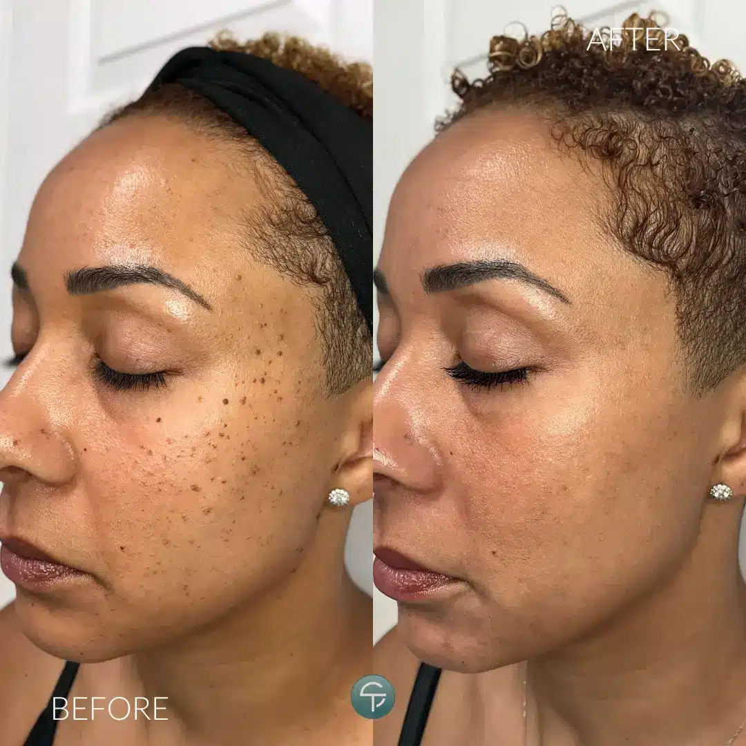 DPN removal before and after results showing smoother skin by Skintellect Laser & Aesthetics Tampa