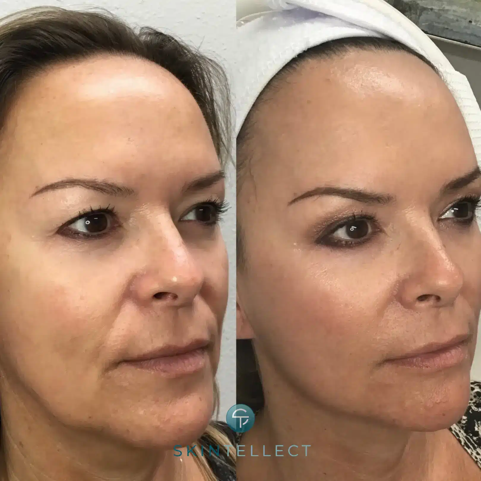 Before and after Fotona 4D Laser Facelift showing noticeable skin tightening and wrinkle reduction.