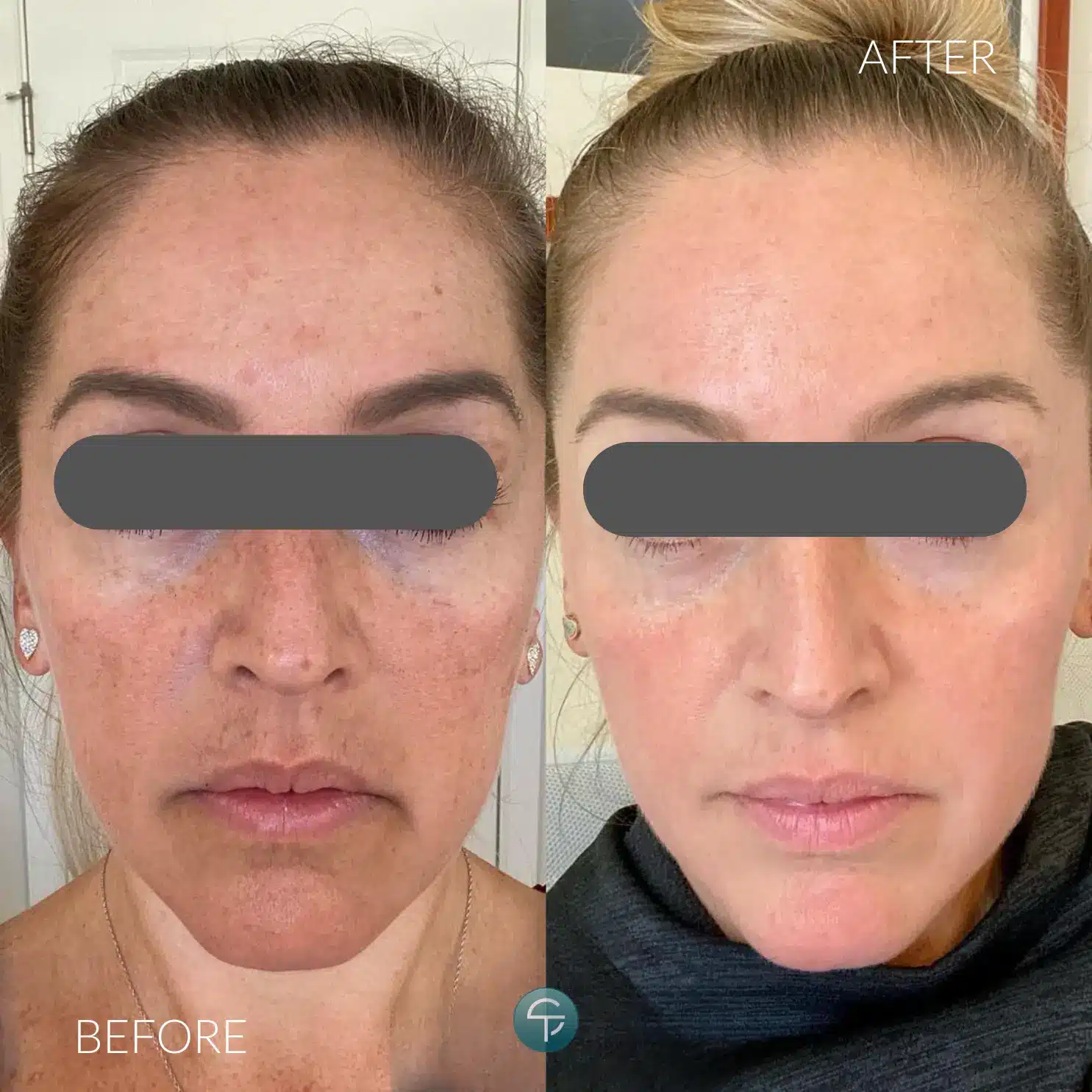 Laser Pigment Removal | Laser Smooth Eye