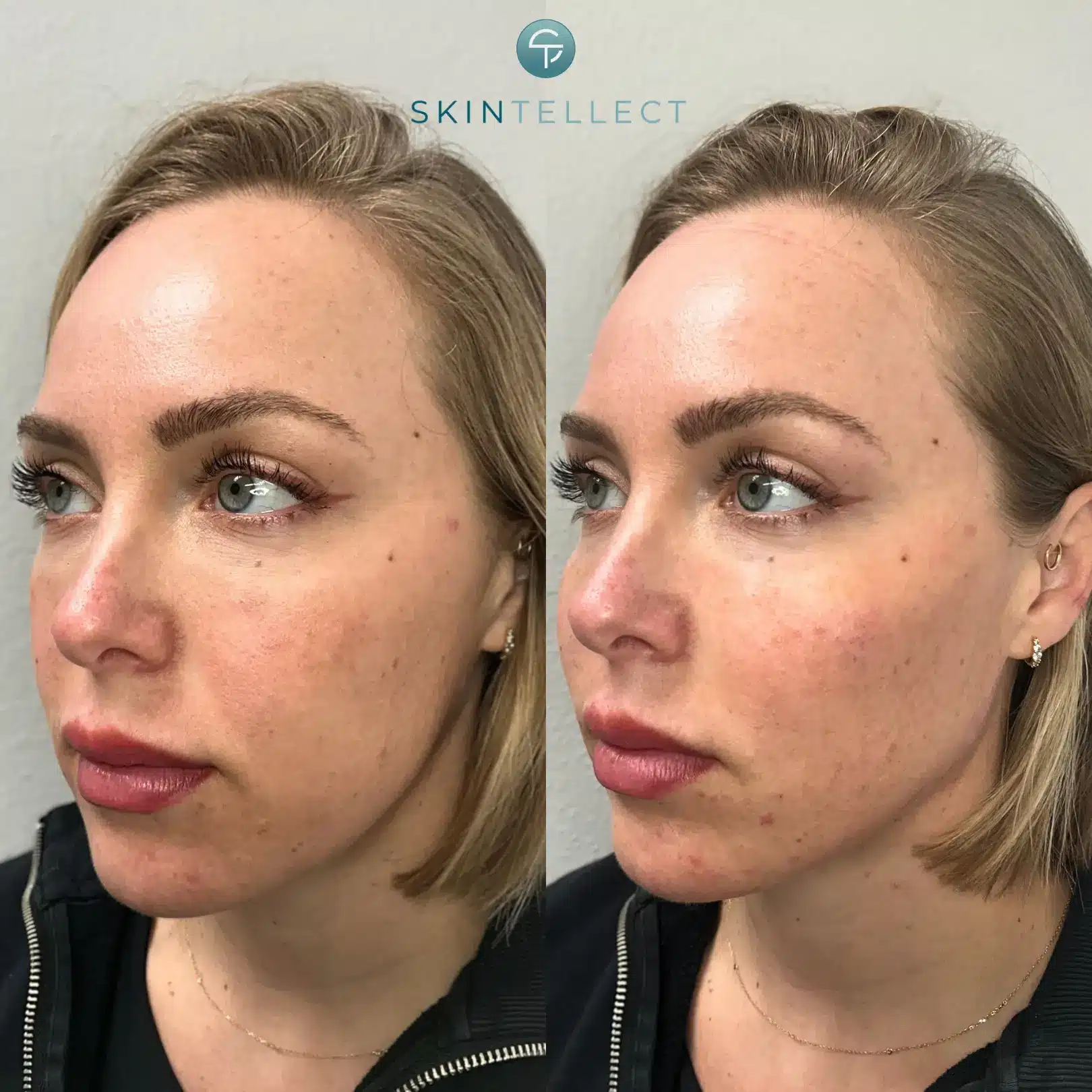 Before and after Sculptra treatment at Skintellect Laser & Aesthetics