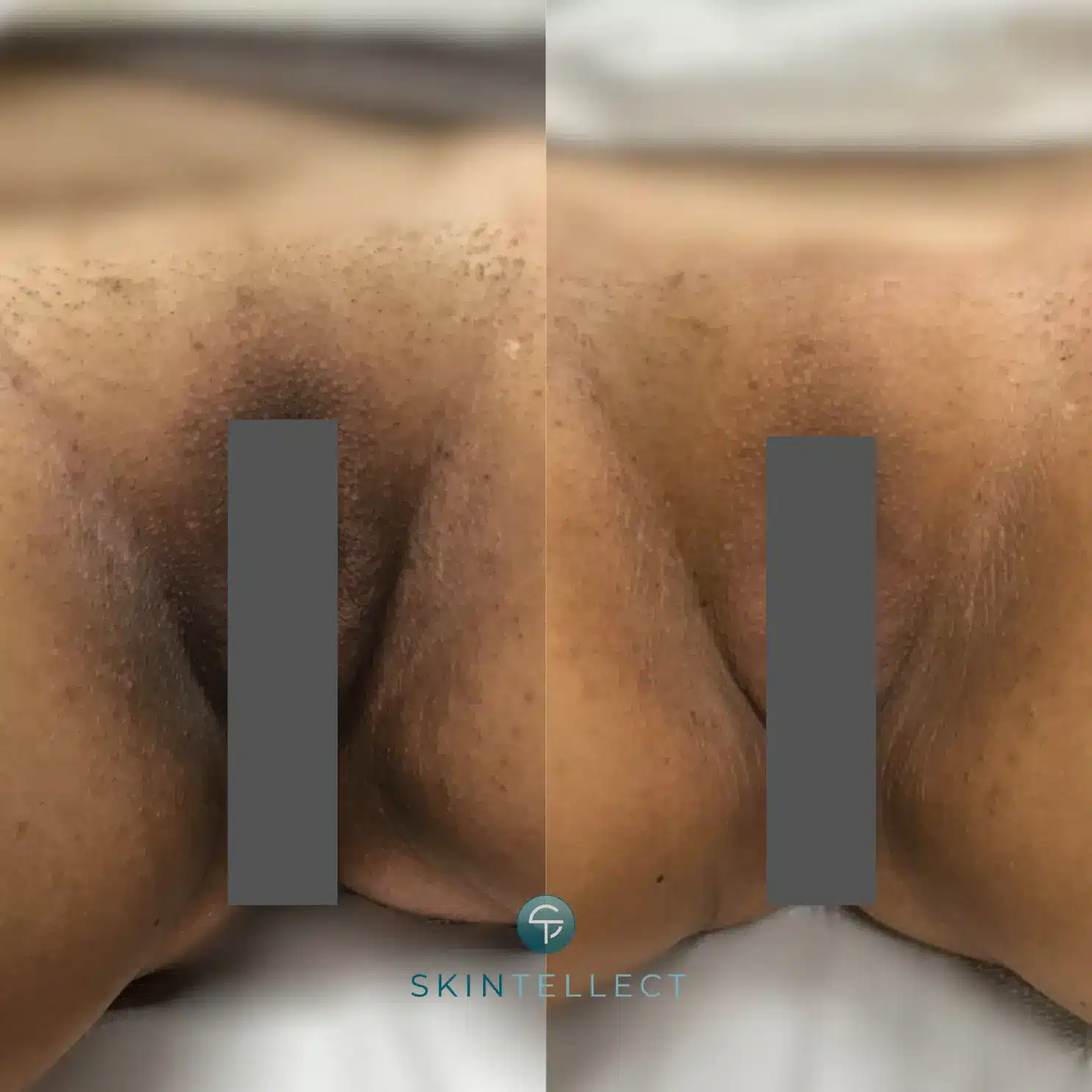 Before and after of vaginal lightening treatment reducing pigmentation and dark spots.