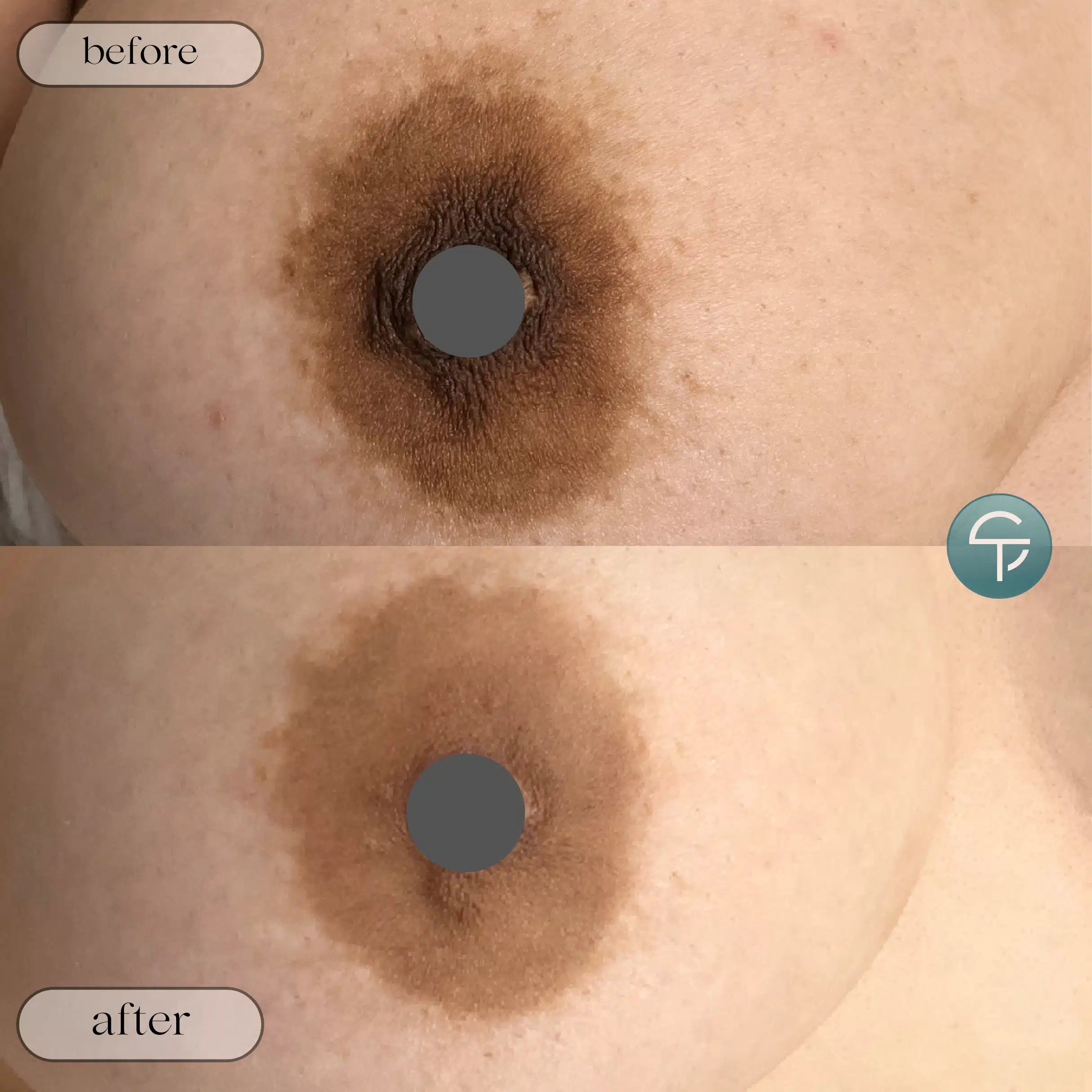 Before and after of laser intimate lightening for areola area, offering a more even skin tone.