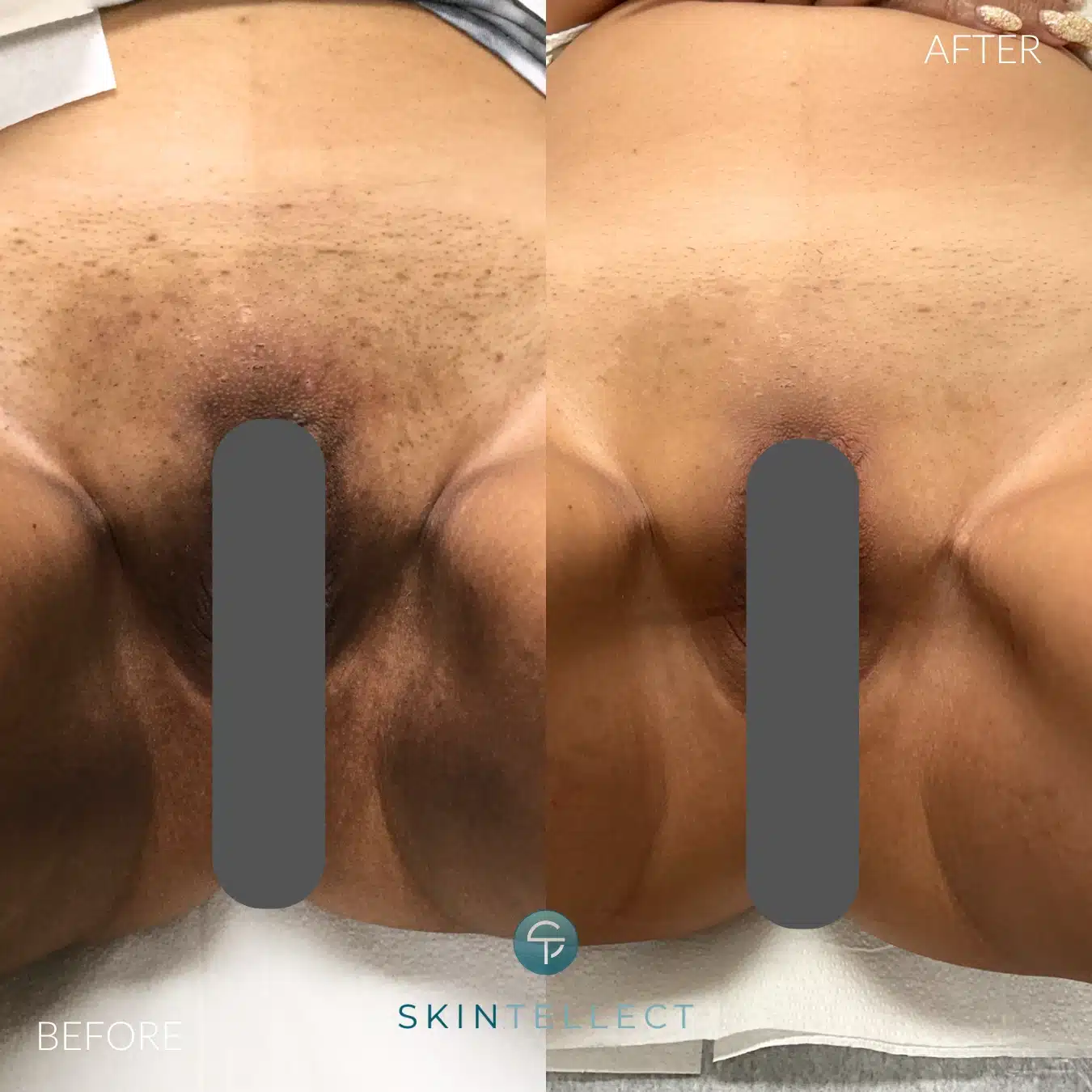 Before and after results of combined vaginal lightening and hair removal treatment.