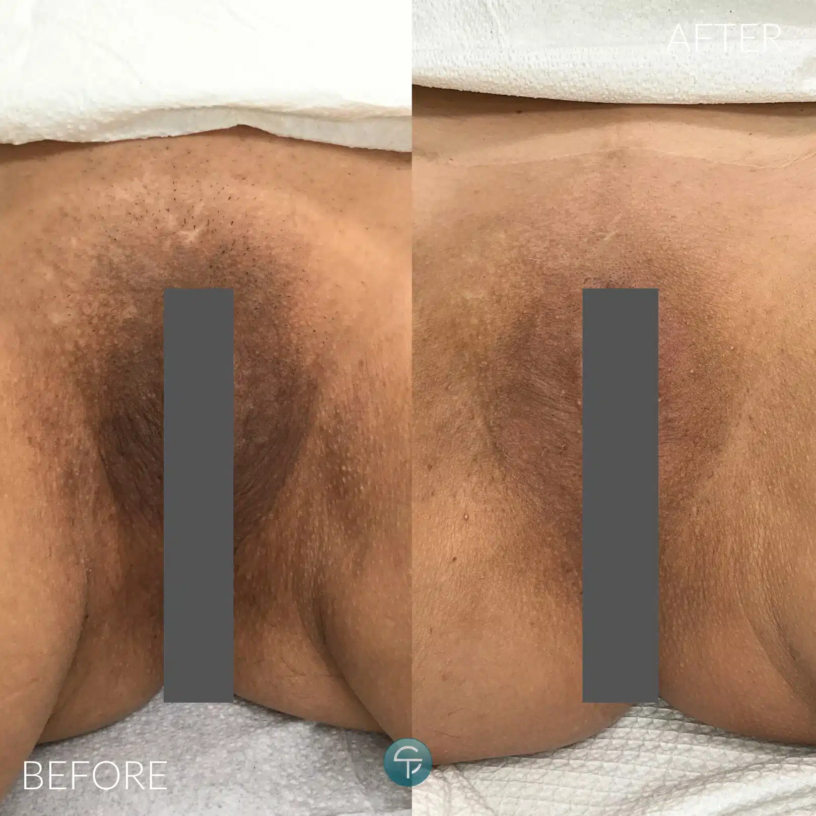 Before and after of Brazilian intimate lightening treatment for a smoother, brighter look.