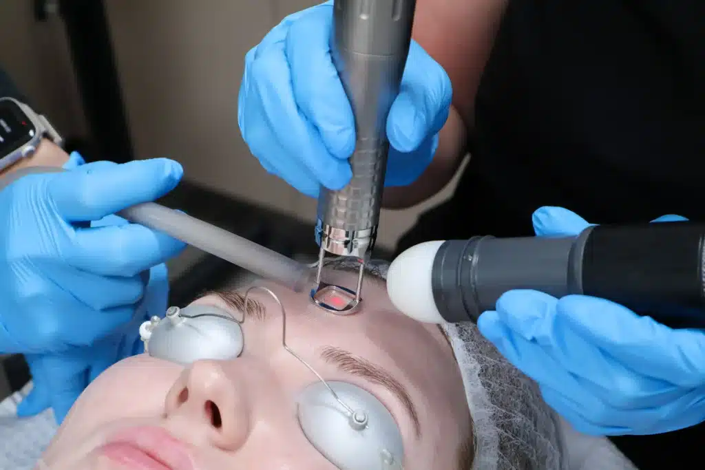 ClearLase laser treatment targeting pitted acne scars for smoother, more even skin texture.