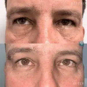 Before and after results of Fotona SmoothEye treatment at Skintellect Laser & Aesthetics