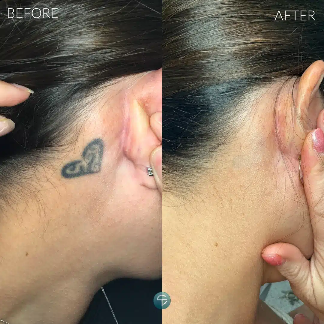 Behind the ear before and after tattoo removal, showing a fully faded black tattoo after six sessions.