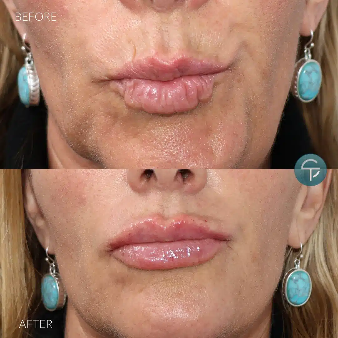 Close-up of lips before and after lip filler treatment, showing wrinkles when puckering in the 'before' image and plump, smooth lips in the 'after' image.