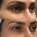 Fotona SmoothEye before and after showing firmer, youthful skin around the eyes