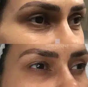 Fotona SmoothEye before and after showing firmer, youthful skin around the eyes